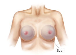New breast fold 3 esprit® cosmetic surgeons