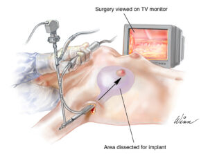 Breast augmentation esprit® cosmetic surgeons