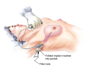 saline breast implant