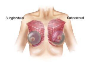 Drawing of breast implants above and under the pectoralis muscle esprit® cosmetic surgeons