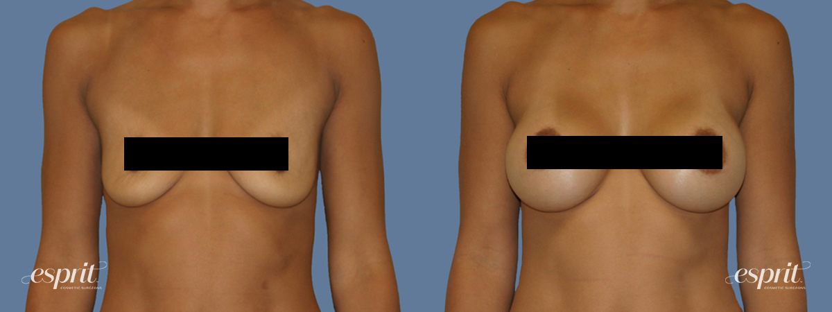 Case1251 front censored2 esprit® cosmetic surgeons