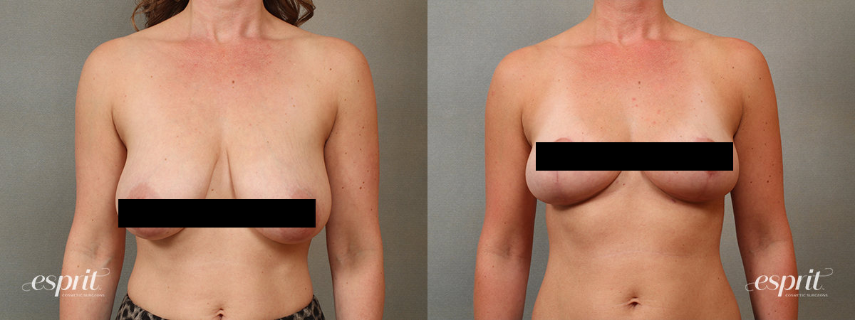 best breast reduction surgery near me