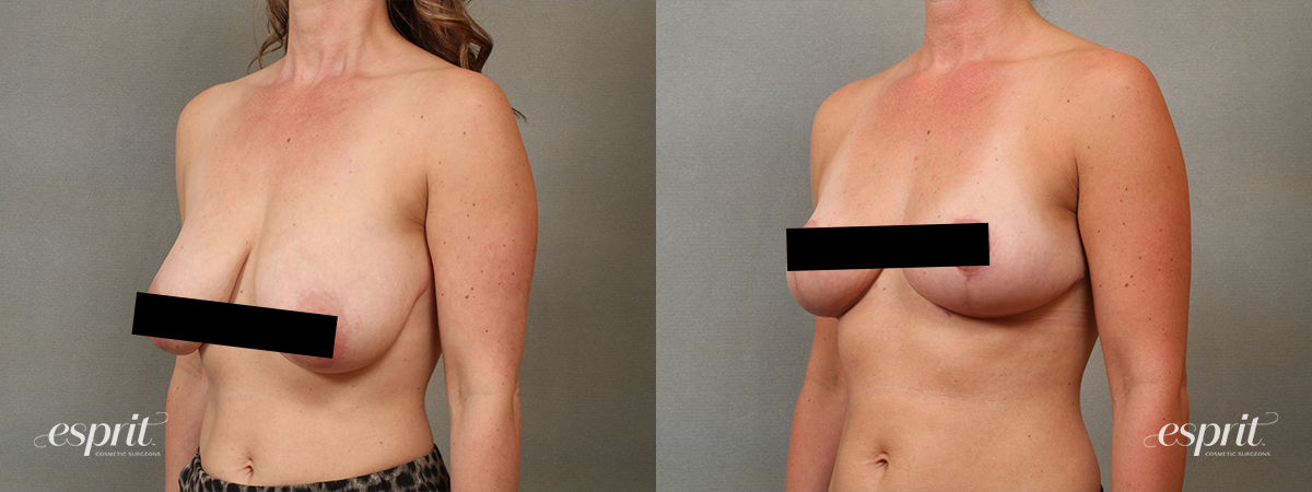 Case1670 side2 censored2 esprit® cosmetic surgeons