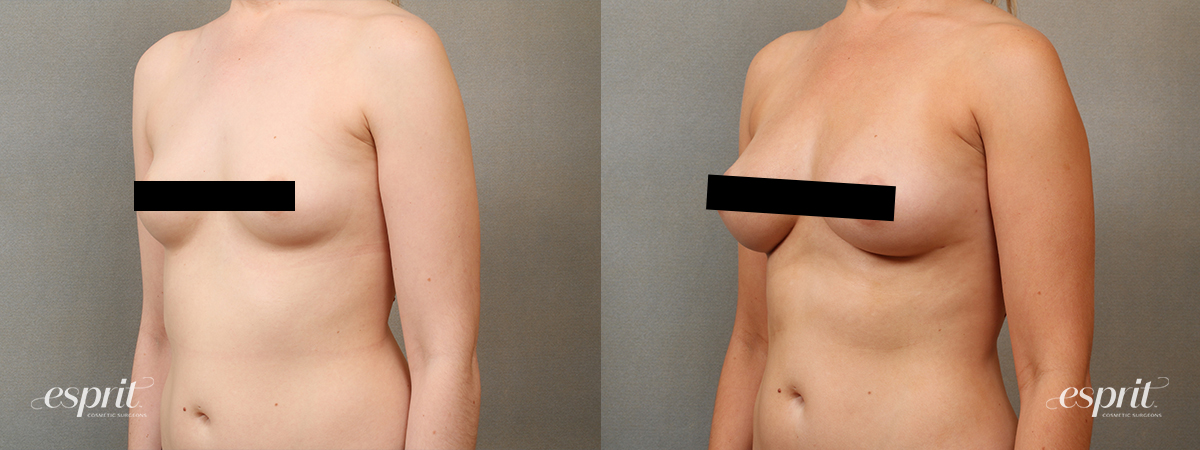 Esprit_Fat-Grafting_Case2203_Oblique_Censored2