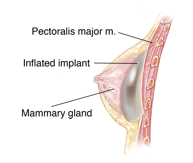 Woman breast implant cross section. Comparison diagram, under and