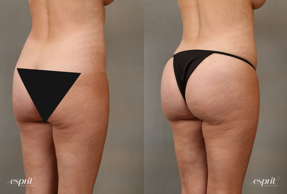 Esprit tualatin brazillian buttock lift case2108 oblique censored esprit® cosmetic surgeons