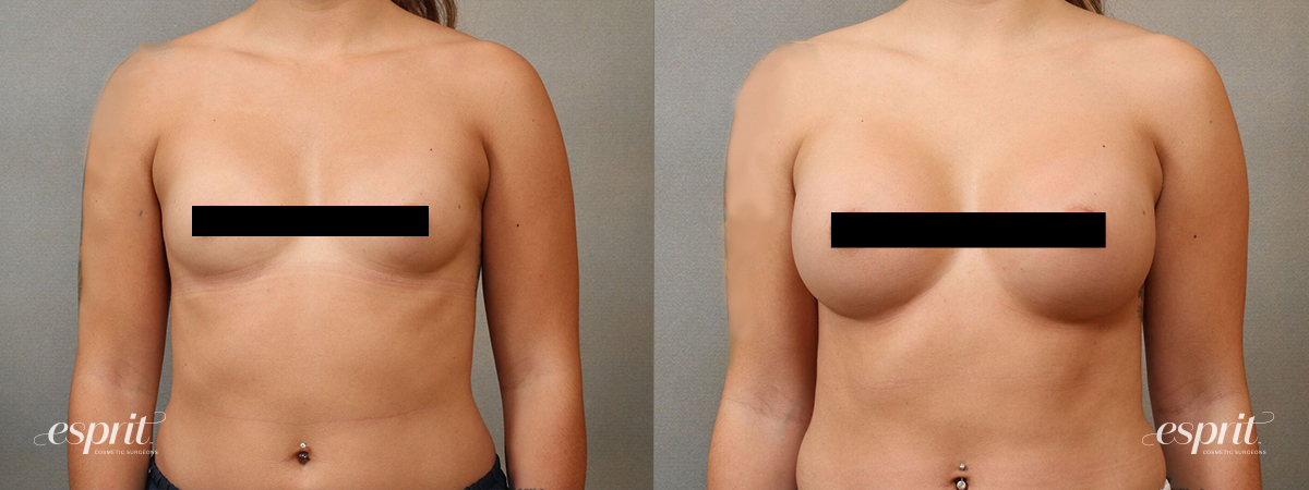 Esprit_Tualatin_Breast_Augmentation_Case4111_Front_Censored