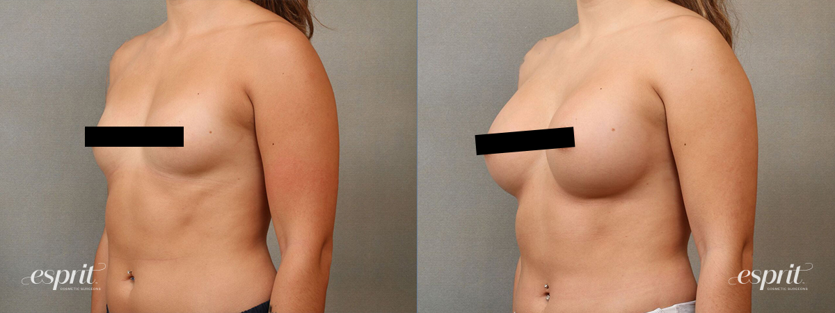 Teardrop vs. Round Implants: Which Breast Implants Are Right For Me?