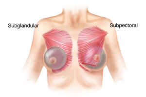 Drawing showing subglandular and subpectoral implant placement esprit® cosmetic surgeons