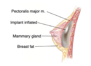 Understanding Pectoralis in Breast Augmentation