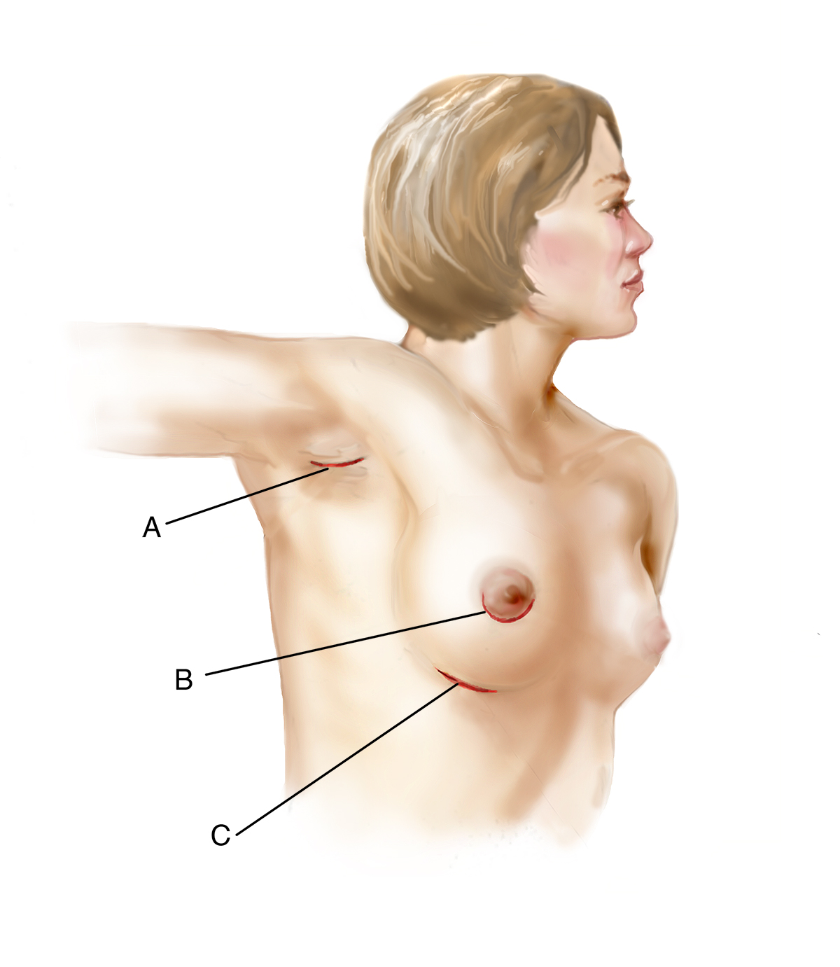 Breast augmentation incisions illustration esprit® cosmetic surgeons
