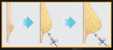 Fat transfer illustration esprit® cosmetic surgeons