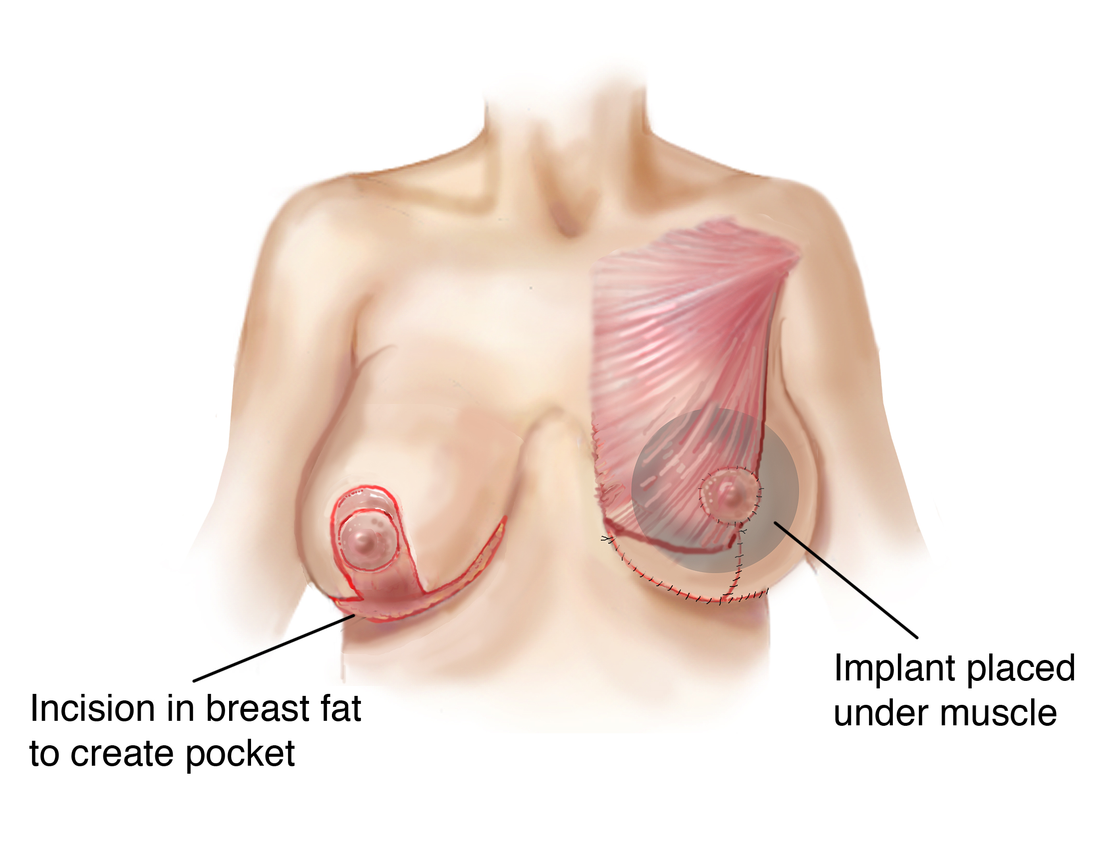 Drawing of dual plane breast implant placement esprit® cosmetic surgeons