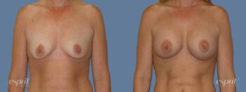 Case 1249 before and after front view esprit® cosmetic surgeons