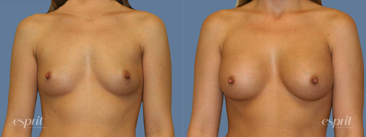 Case 1256 before and after front view esprit® cosmetic surgeons