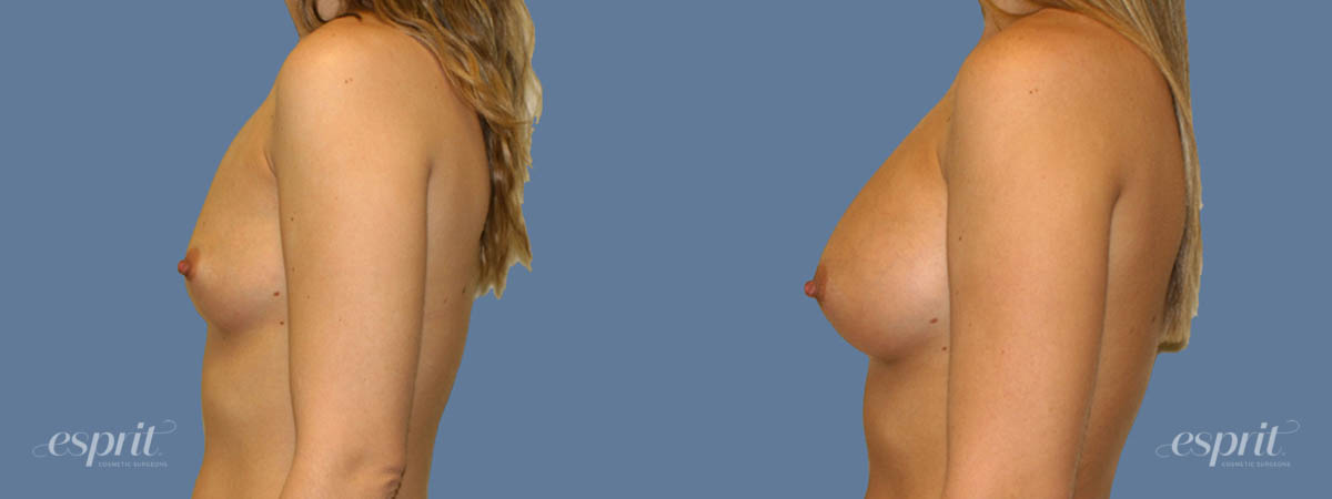 Case 1256 before and after left side view esprit® cosmetic surgeons