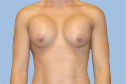 one week After breast augmentation