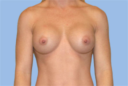 3 months After breast augmentation