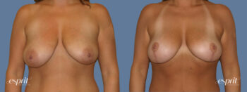 Case 1246 before and after front view esprit® cosmetic surgeons