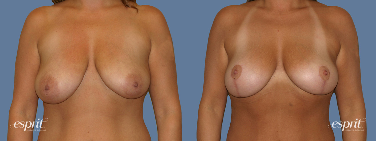 Case 1246 before and after front view esprit® cosmetic surgeons