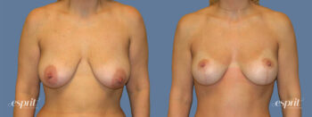 Case 1306 before and after front view esprit® cosmetic surgeons