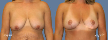Case 1308 before and after front view esprit® cosmetic surgeons