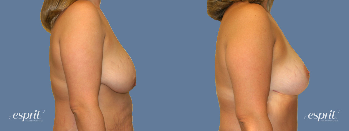 Case 1308 before and after right side view esprit® cosmetic surgeons