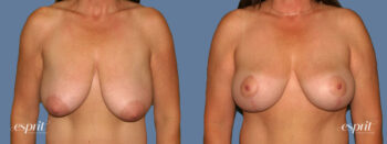 Case 1312 before and after front view esprit® cosmetic surgeons