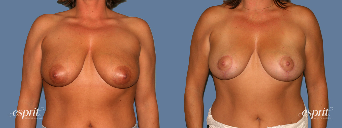 Case 1313 before and after front view esprit® cosmetic surgeons
