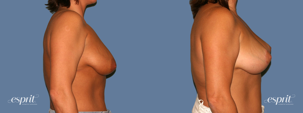 Case 1313 before and after right side view esprit® cosmetic surgeons