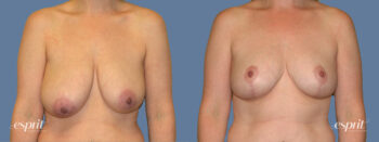 Case 1315 before and after front view esprit® cosmetic surgeons