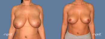 Case 1320 before and after front view esprit® cosmetic surgeons