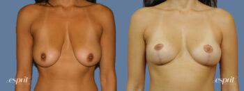 Case 1380 before and after front view esprit® cosmetic surgeons