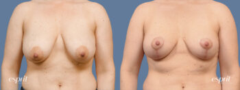 Case 1445 before and after front view esprit® cosmetic surgeons