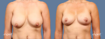 Case 1520 before and after front view esprit® cosmetic surgeons
