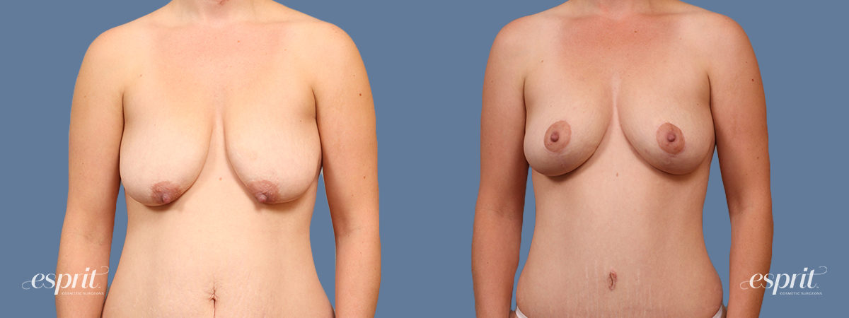 Case 1614 Breast Lift with Fat Grafting Before and After Front View