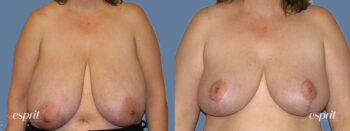Breast augmentation 317 front esprit® cosmetic surgeons