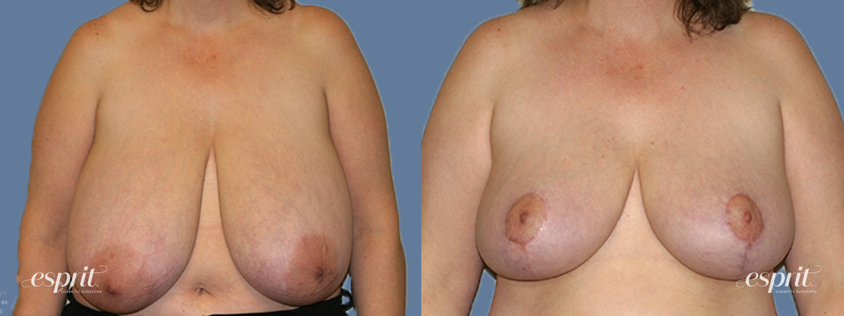 Breast Augmentation 317, Front