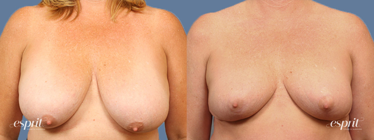 Breast augmentation 1495 front esprit® cosmetic surgeons