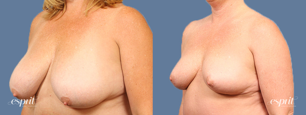 Breast augmentation 1495 oblique esprit® cosmetic surgeons