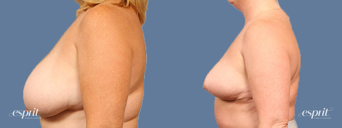 Breast augmentation 1495 side esprit® cosmetic surgeons