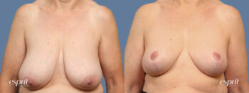 Breast augmentation 1545 front esprit® cosmetic surgeons