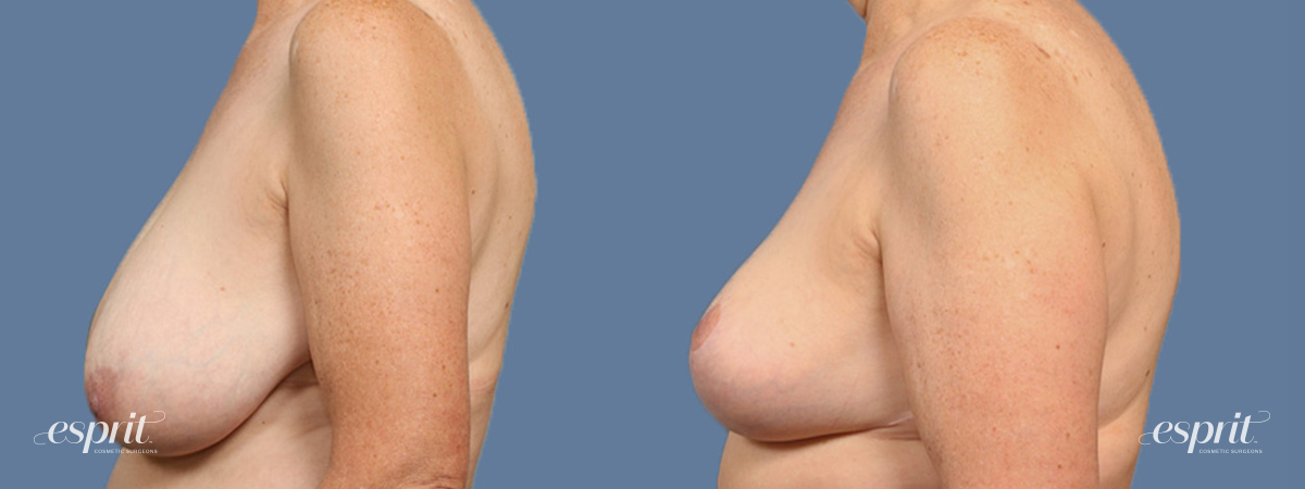 Breast Augmentation 1545, Side