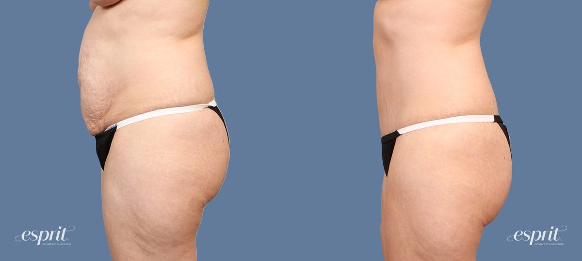 Case 1524 before and after left side view esprit® cosmetic surgeons