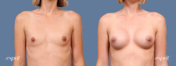 Breast augmentation 1686 front esprit® cosmetic surgeons