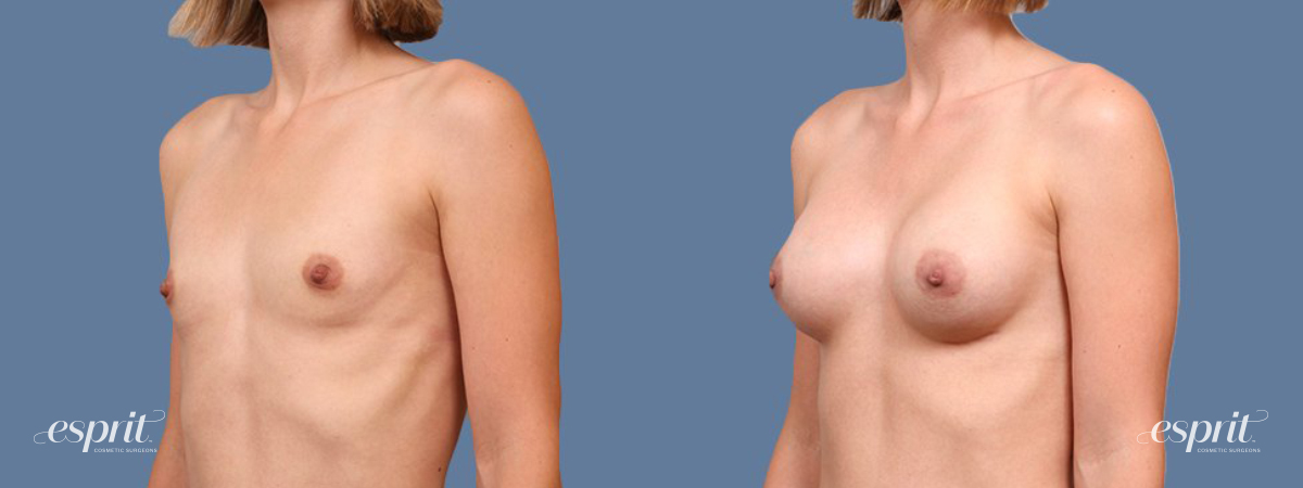 Breast Augmentation 1686, Oblique