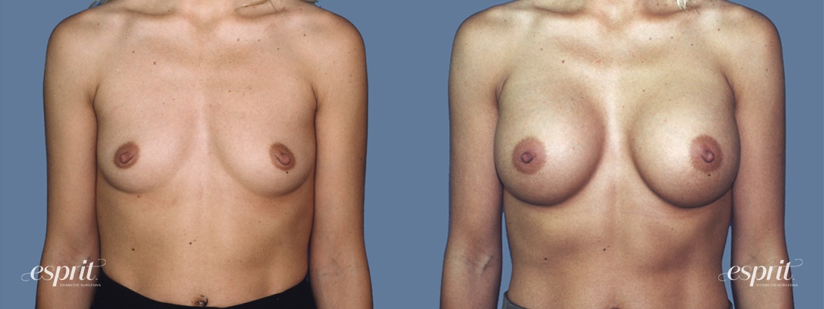 Case 1244 before and after front view esprit® cosmetic surgeons