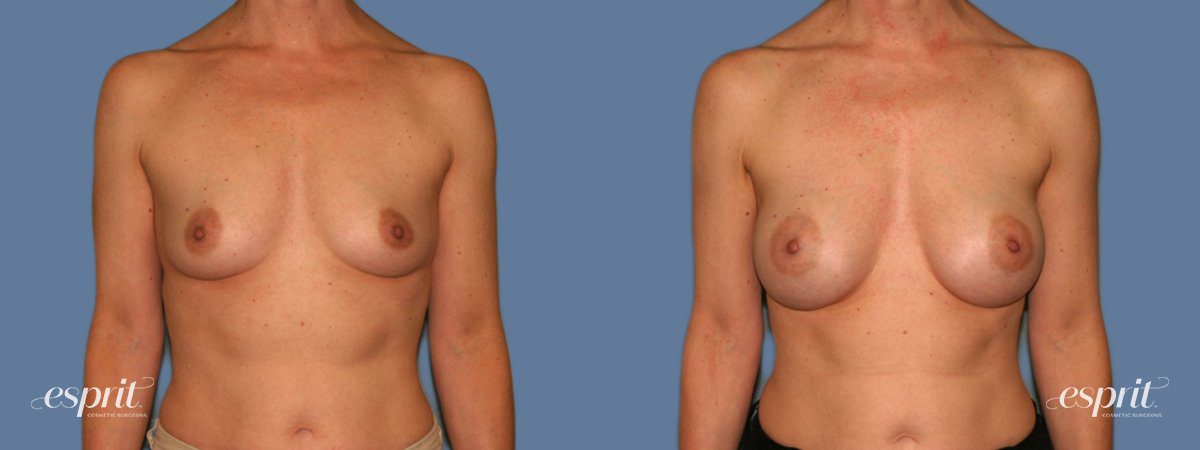 Case 1281 before and after front view esprit® cosmetic surgeons