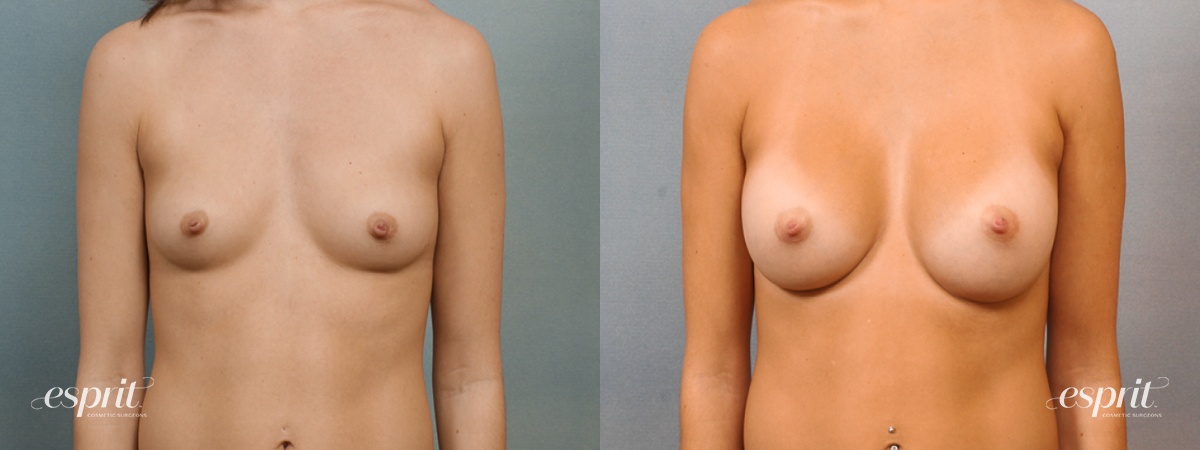 Case 1433 before and after front view esprit® cosmetic surgeons