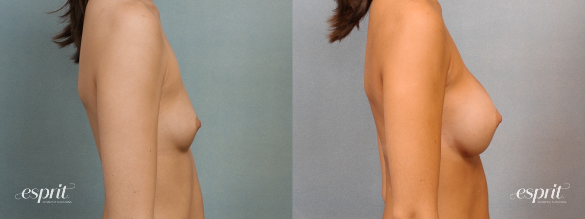 Case 1433 before and after right side view esprit® cosmetic surgeons